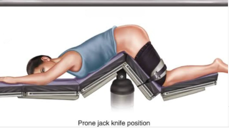Jackknife Prone Position Surgery Jackknife Prone Position Surgery
