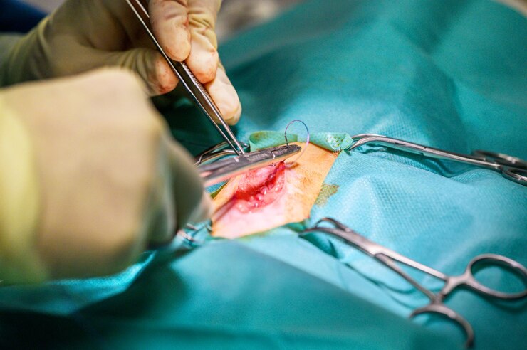Penectomy Surgery Penectomy Surgery