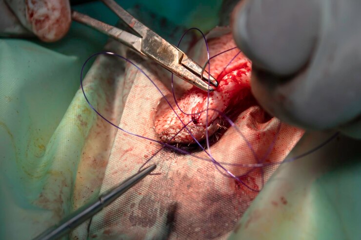Frey Flap Surgery Frey Flap Surgery